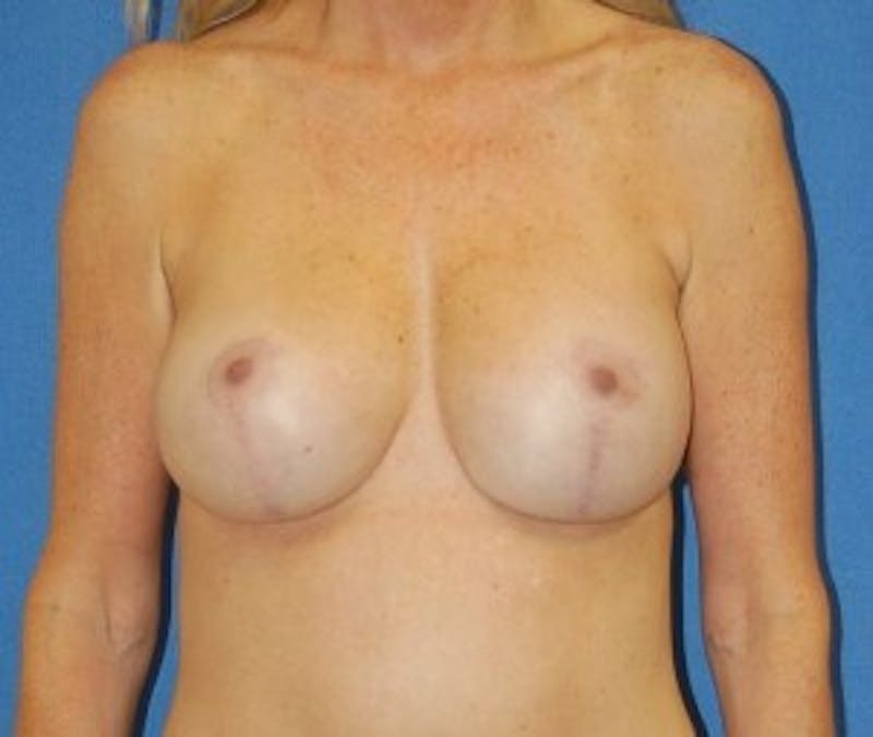 Breast Revision Before & After Gallery - Patient 91458887 - Image 2