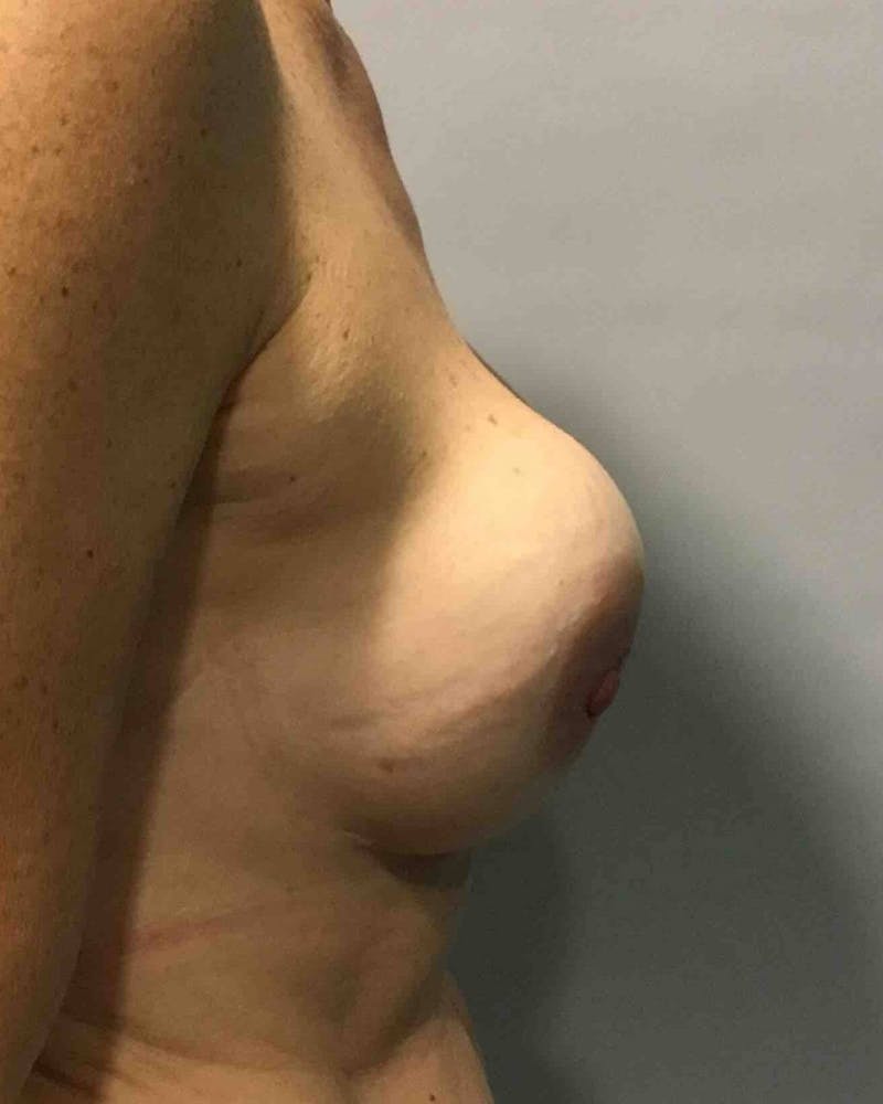 Breast Revision Before & After Gallery - Patient 91458897 - Image 5