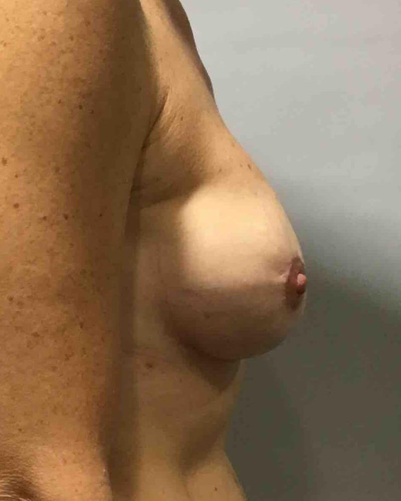 Breast Revision Before & After Gallery - Patient 91458897 - Image 6