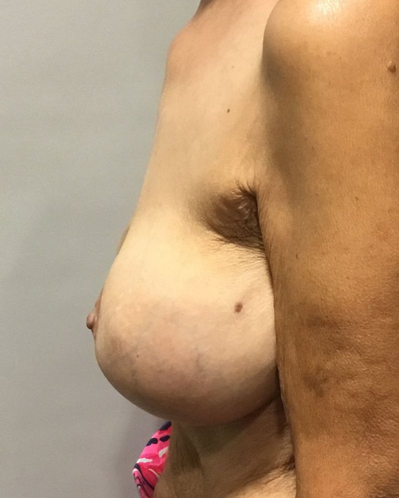 Breast Revision Before & After Gallery - Patient 91458901 - Image 3