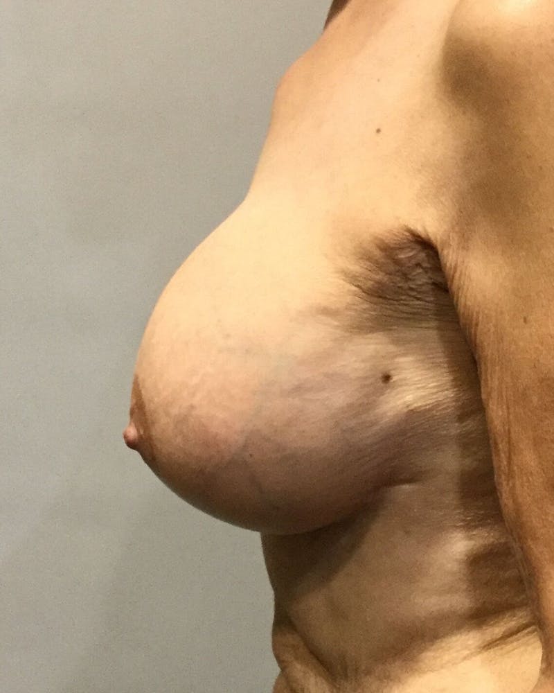 Breast Revision Before & After Gallery - Patient 91458901 - Image 4