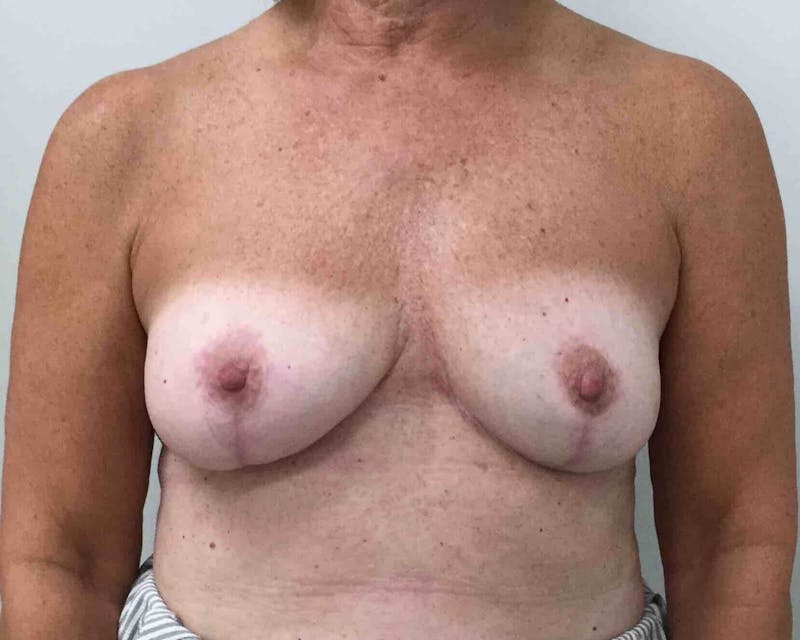 Breast Revision Before & After Gallery - Patient 91458903 - Image 2