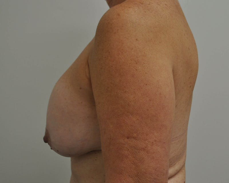 Breast Revision Before & After Gallery - Patient 91458903 - Image 3