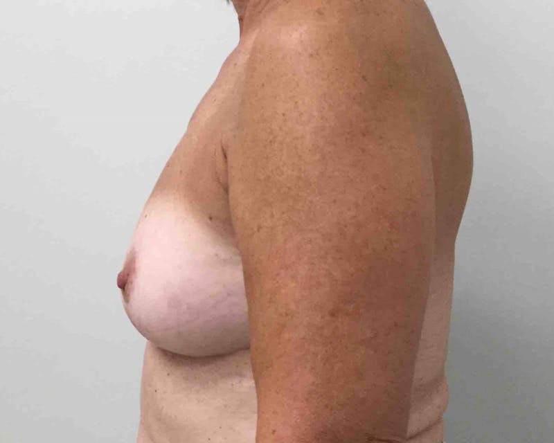 Breast Revision Before & After Gallery - Patient 91458903 - Image 4