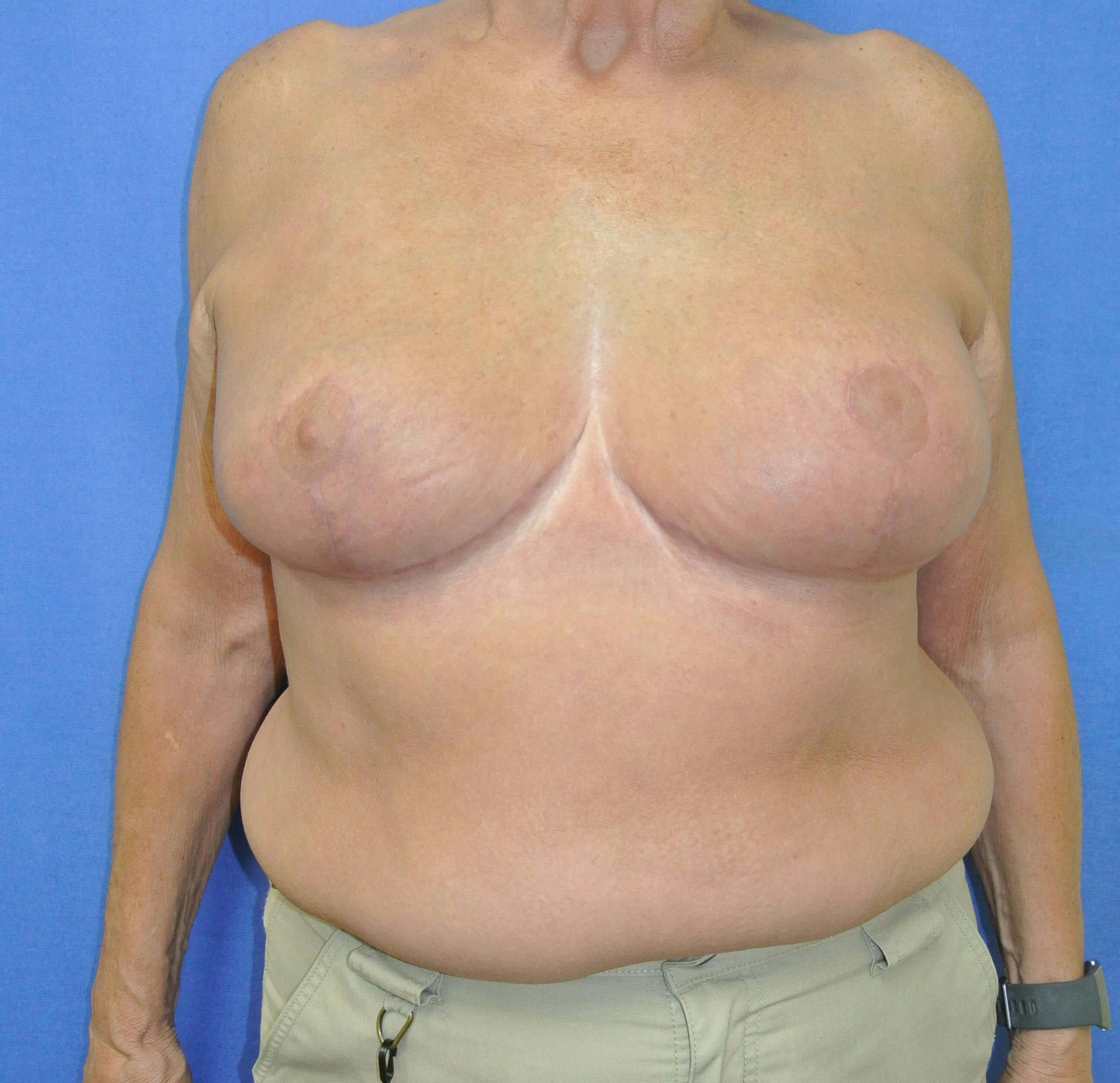 Breast Reduction Gallery - Patient 91458927 - Image 2