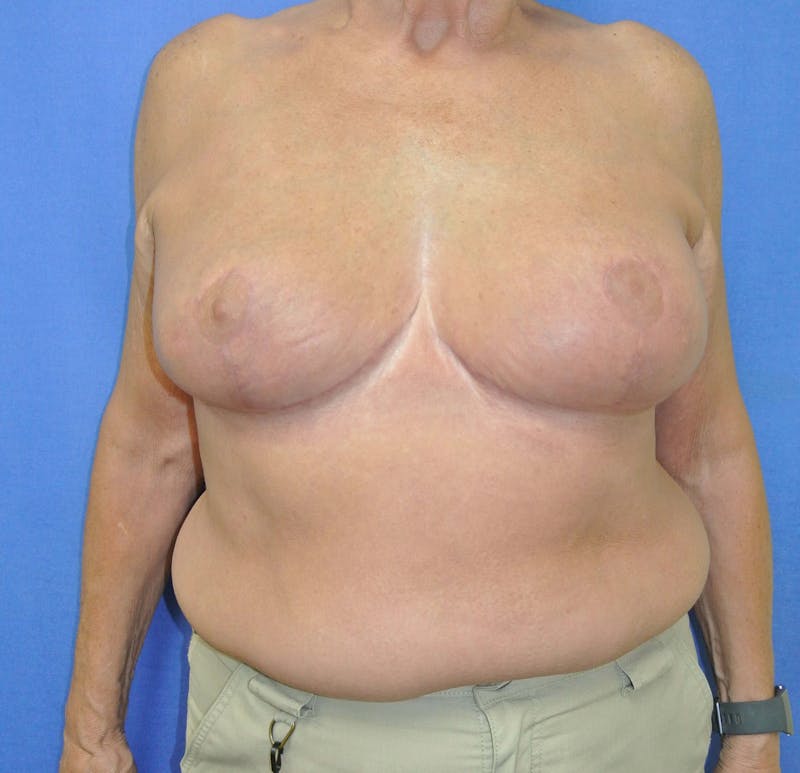 Breast Reduction Before & After Gallery - Patient 91458927 - Image 2