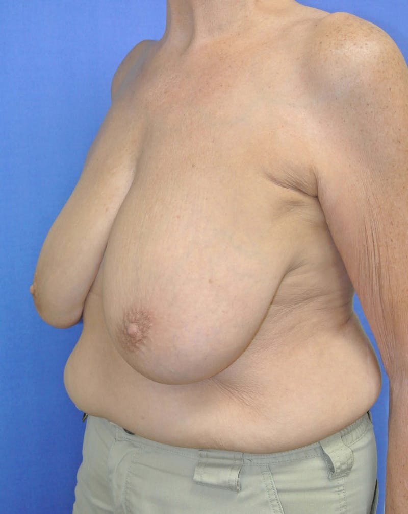 Breast Reduction Before & After Gallery - Patient 91458927 - Image 3