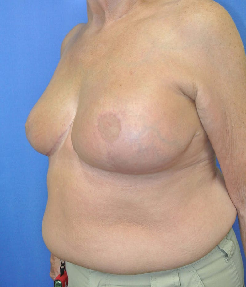 Breast Reduction Before & After Gallery - Patient 91458927 - Image 4