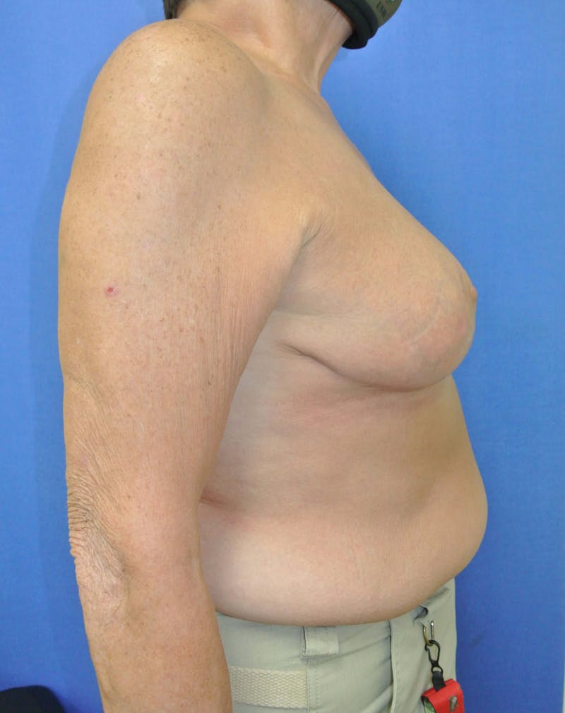 Breast Reduction Before & After Gallery - Patient 91458927 - Image 6