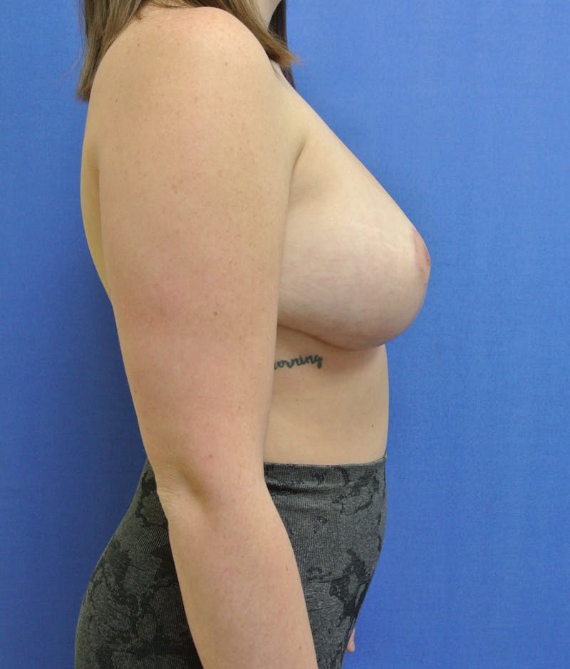 Breast Reduction Gallery - Patient 91458931 - Image 6