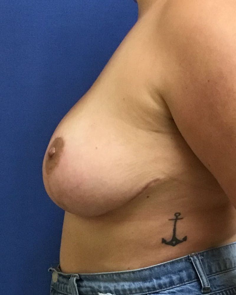 Breast Reduction Before & After Gallery - Patient 91458935 - Image 6