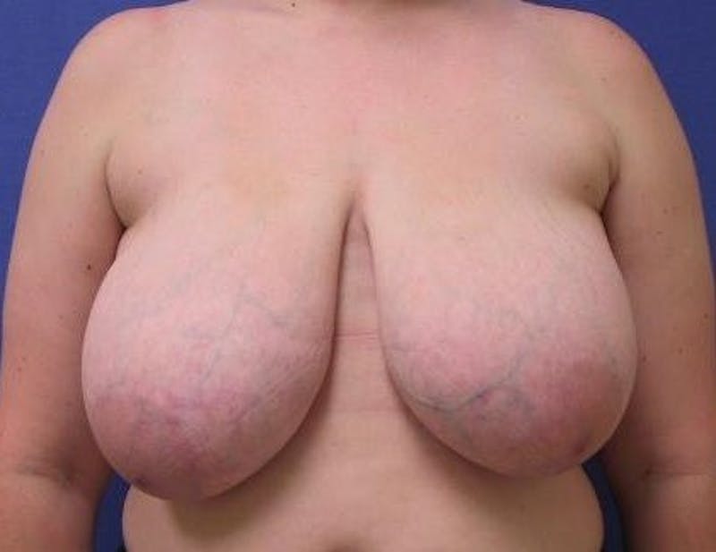Breast Reduction Before & After Gallery - Patient 91458938 - Image 1
