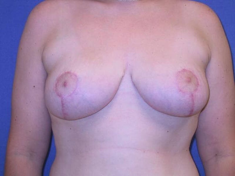Breast Reduction Before & After Gallery - Patient 91458938 - Image 2