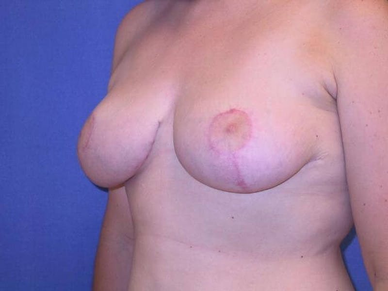 Breast Reduction Before & After Gallery - Patient 91458938 - Image 4