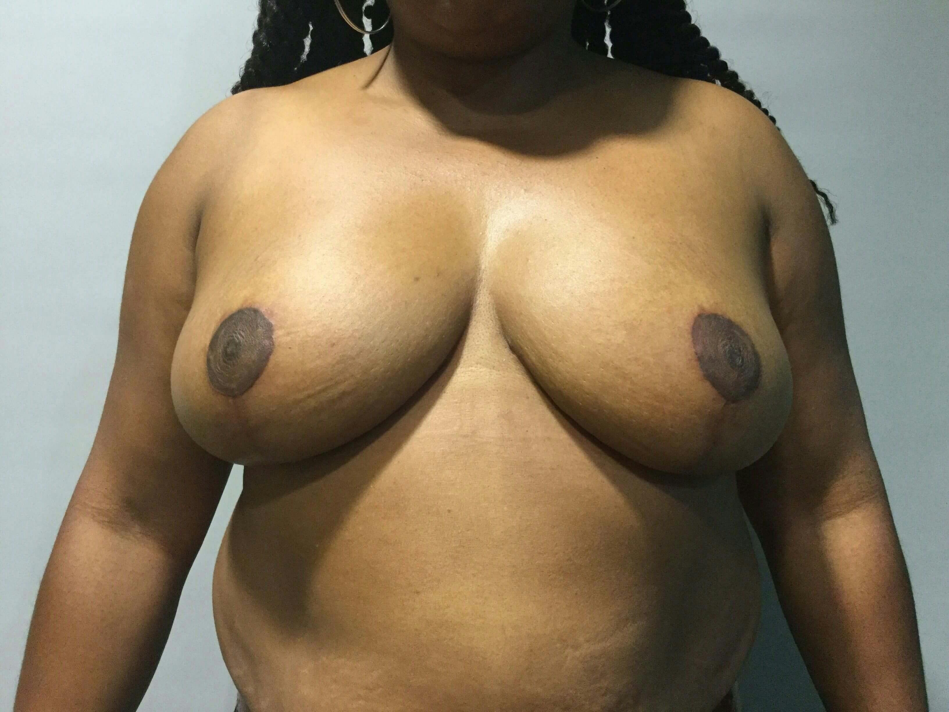 Breast Reduction Gallery - Patient 91458945 - Image 2