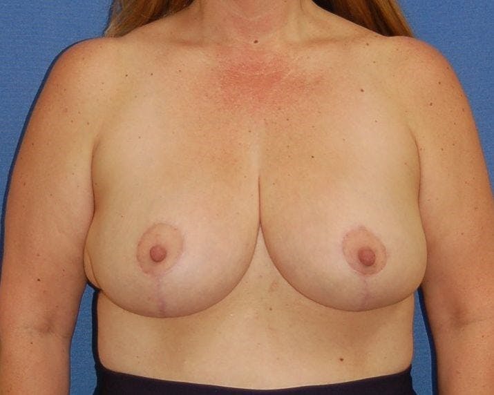 Breast Reduction Gallery - Patient 91458951 - Image 2