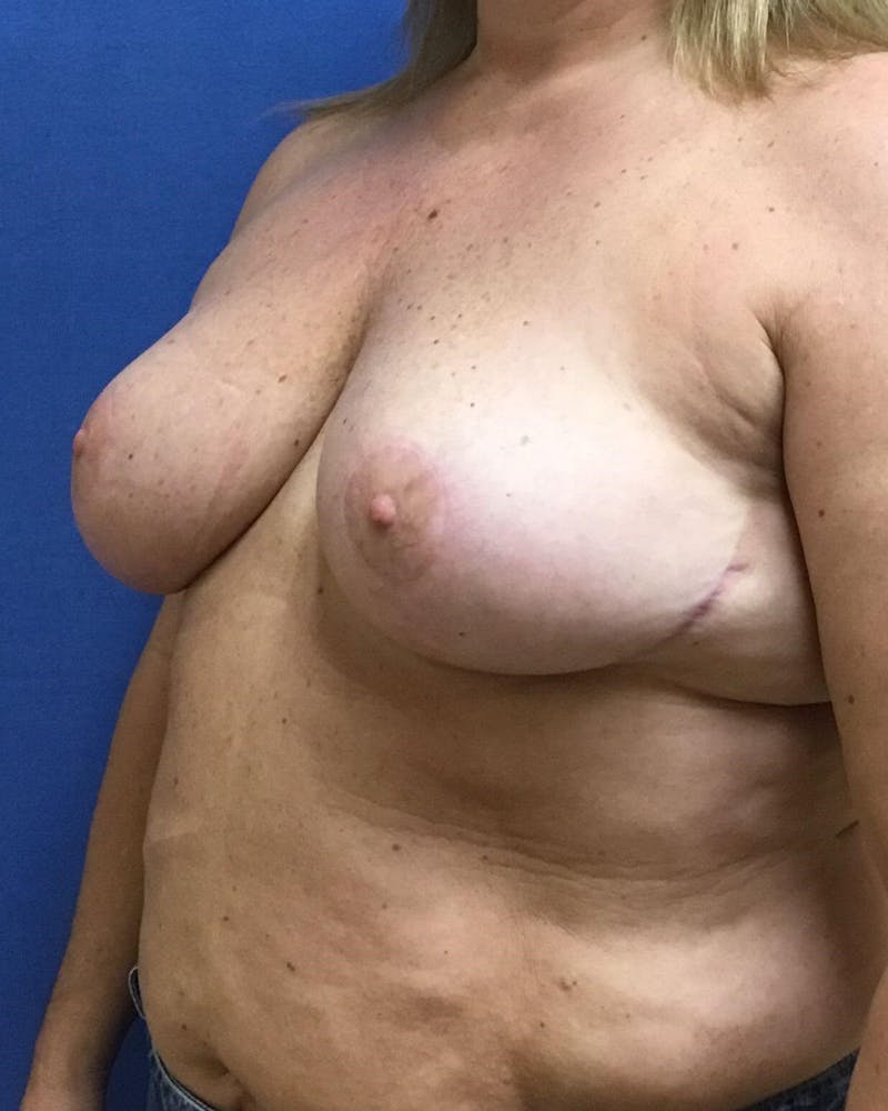 Breast Reduction Gallery - Patient 91458959 - Image 6