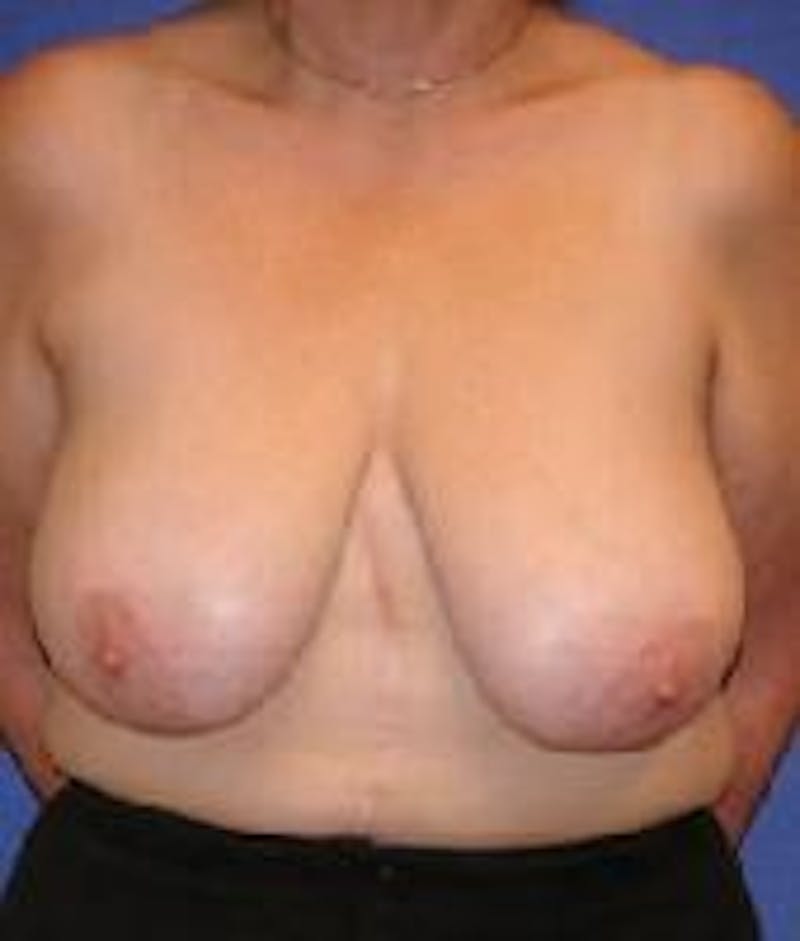 Breast Reduction Before & After Gallery - Patient 91458963 - Image 1