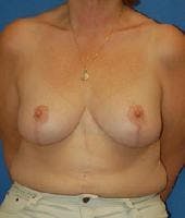 Breast Reduction Gallery - Patient 91458963 - Image 2