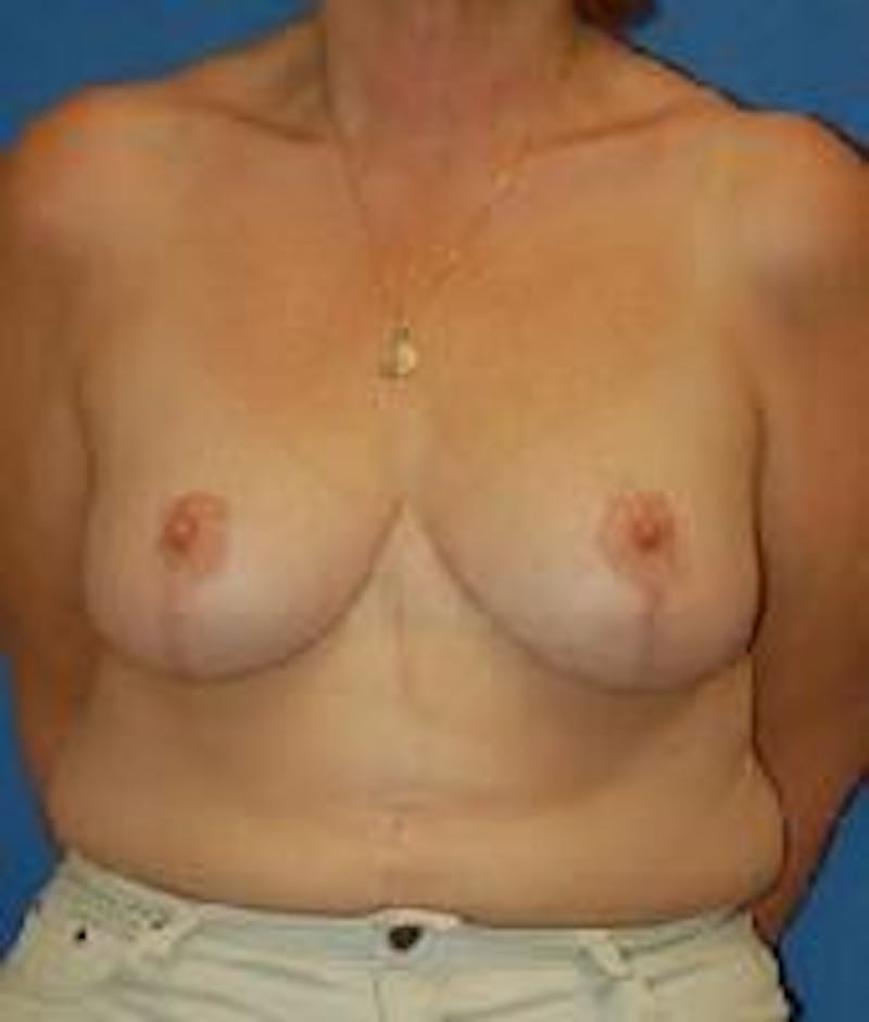 Breast Reduction Before & After Gallery - Patient 91458963 - Image 2