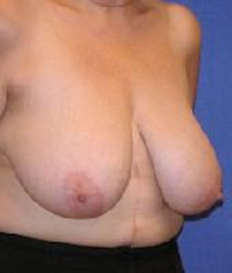 Breast Reduction Before & After Gallery - Patient 91458963 - Image 3