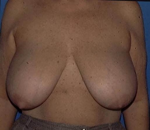 Breast Reduction Gallery - Patient 91458974 - Image 1
