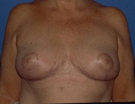 Breast Reduction Gallery - Patient 91458974 - Image 2