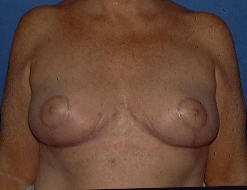 Breast Reduction Before & After Gallery - Patient 91458974 - Image 2