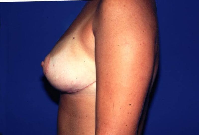 Breast Reduction Before & After Gallery - Patient 91458975 - Image 4