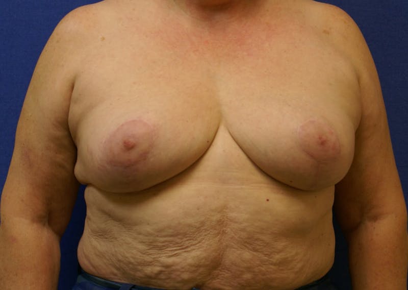 Breast Reduction Gallery - Patient 91458978 - Image 2