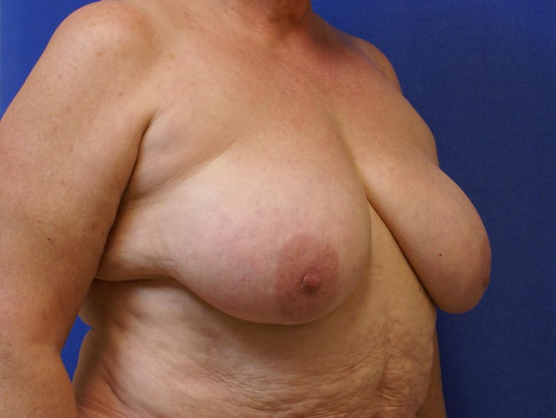 Breast Reduction Before & After Gallery - Patient 91458978 - Image 3