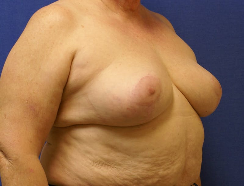 Breast Reduction Before & After Gallery - Patient 91458978 - Image 4