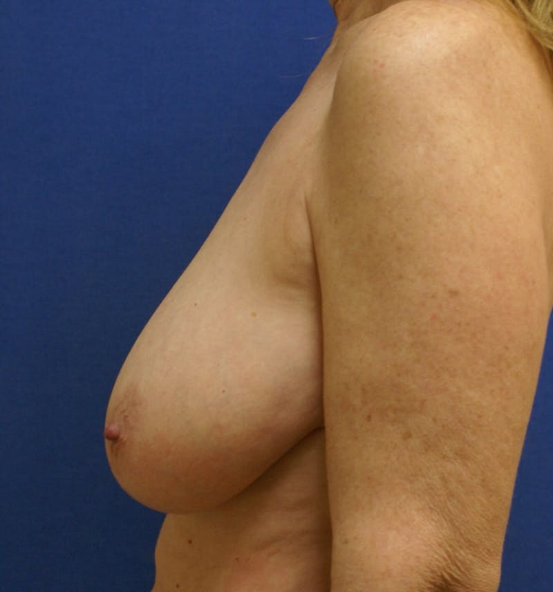 Breast Reduction Before & After Gallery - Patient 91458981 - Image 3
