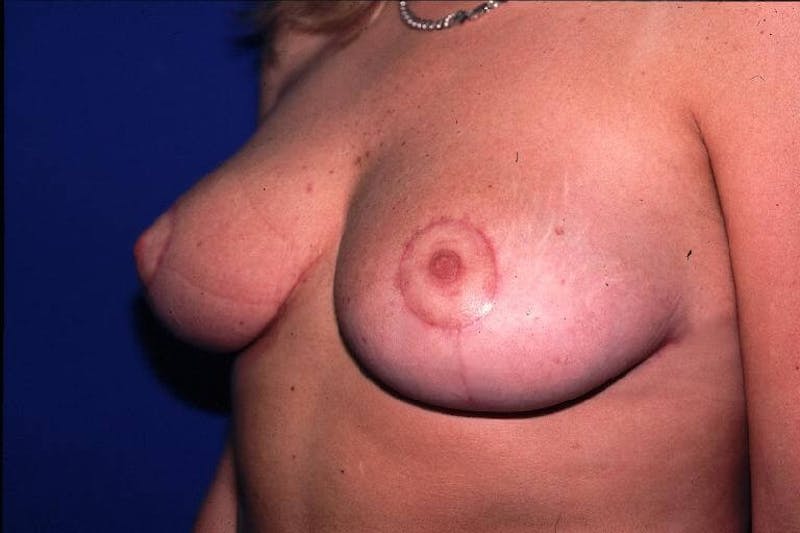 Breast Reduction Before & After Gallery - Patient 91458986 - Image 2