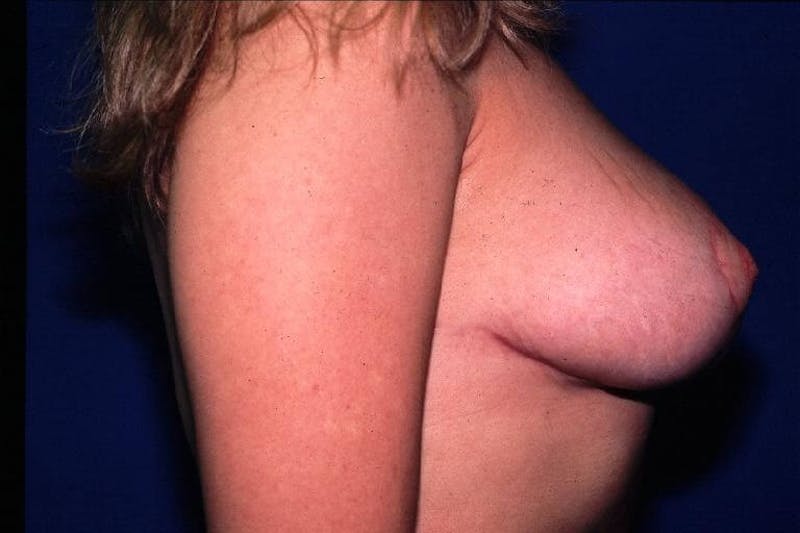 Breast Reduction Before & After Gallery - Patient 91458986 - Image 4