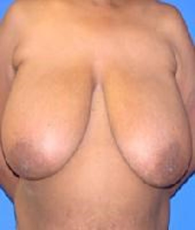 Breast Reduction Before & After Gallery - Patient 91458989 - Image 1