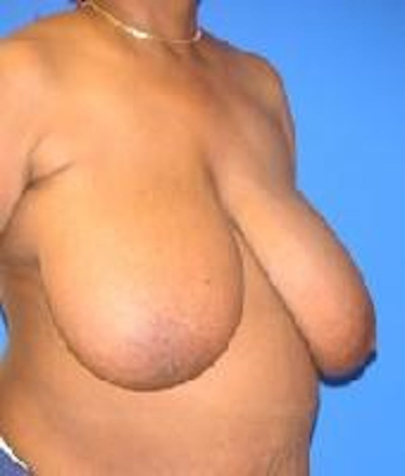 Breast Reduction Before & After Gallery - Patient 91458989 - Image 3