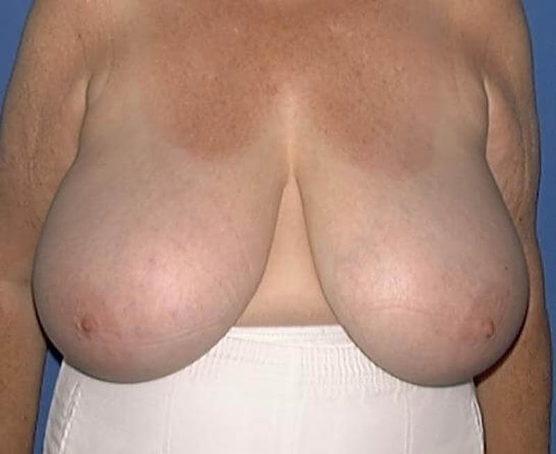 Breast Reduction Before & After Gallery - Patient 91458993 - Image 3