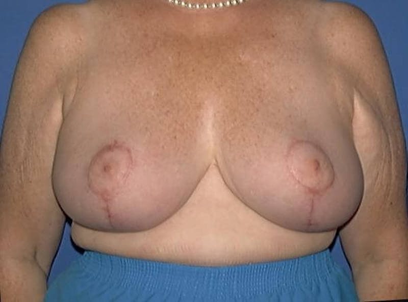 Breast Reduction Before & After Gallery - Patient 91458993 - Image 4