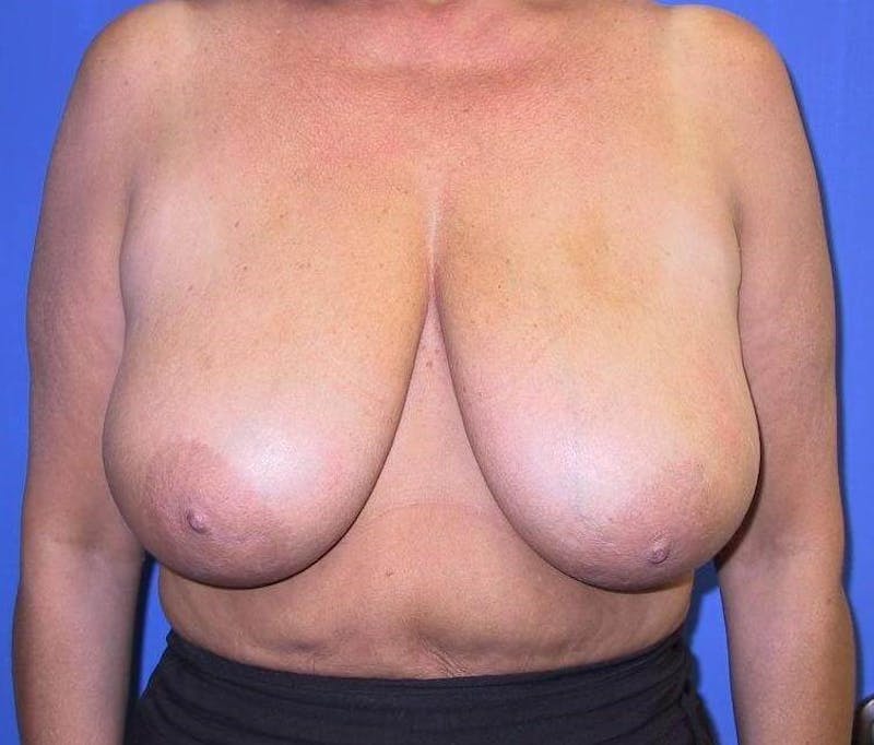 Breast Reduction Before & After Gallery - Patient 91458996 - Image 1