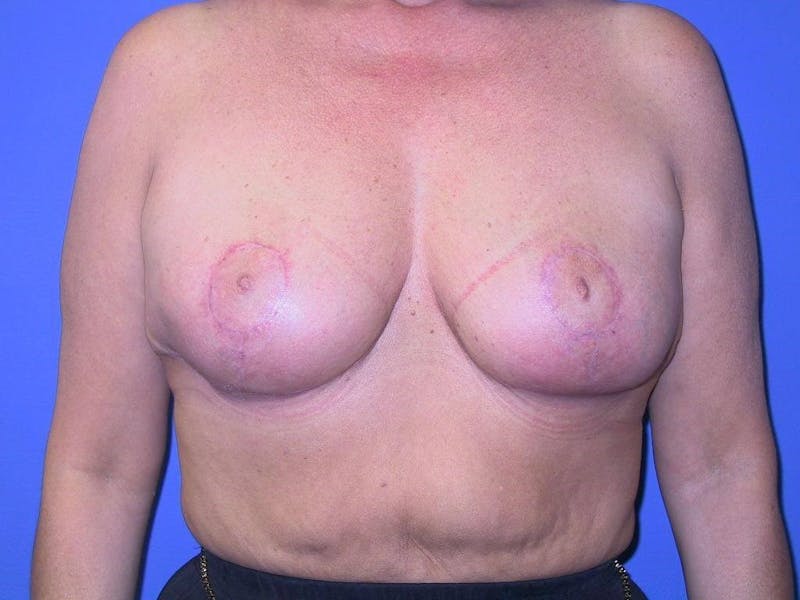 Breast Reduction Before & After Gallery - Patient 91458996 - Image 2