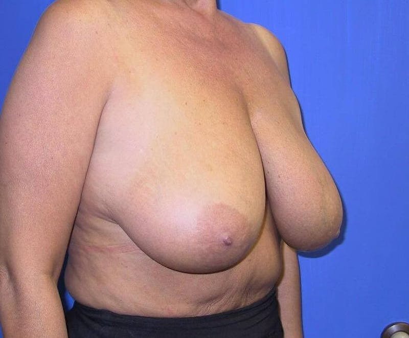 Breast Reduction Before & After Gallery - Patient 91458996 - Image 3