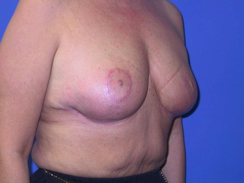 Breast Reduction Before & After Gallery - Patient 91458996 - Image 4