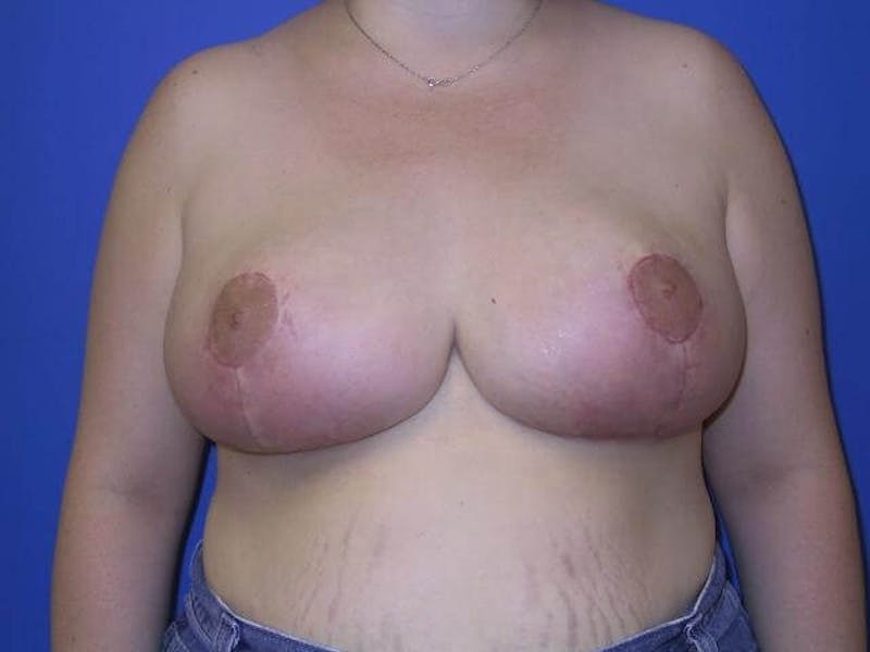 Breast Reduction Before & After Gallery - Patient 91458998 - Image 2