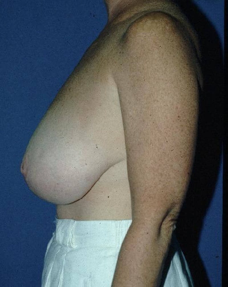 Breast Reduction Before & After Gallery - Patient 91459001 - Image 1