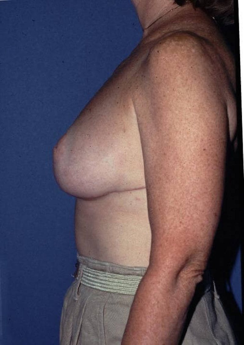 Breast Reduction Before & After Gallery - Patient 91459001 - Image 2