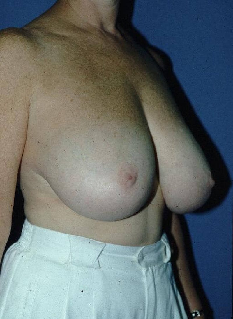 Breast Reduction Before & After Gallery - Patient 91459001 - Image 3