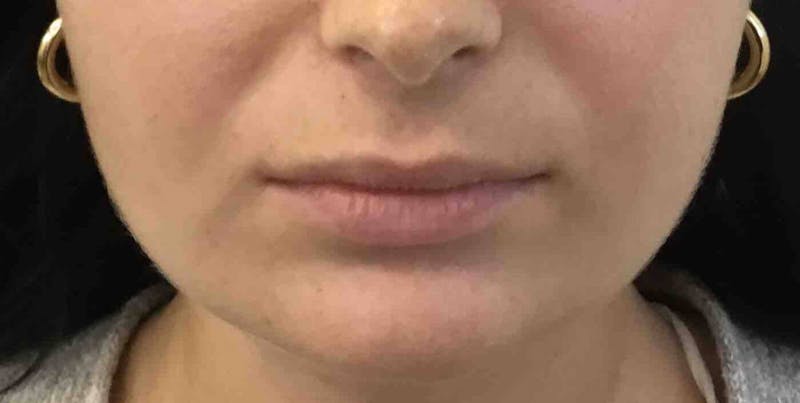 Amy Kadlubowski, APRN Before & After Gallery - Patient 91459002 - Image 1