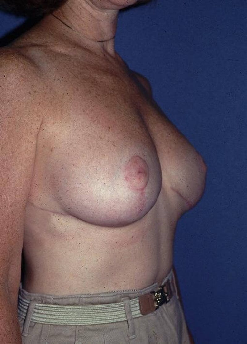 Breast Reduction Before & After Gallery - Patient 91459001 - Image 4