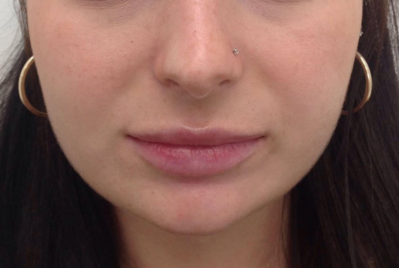 Amy Kadlubowski, APRN Before & After Gallery - Patient 91459002 - Image 2